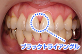 ブラックトライアングル
